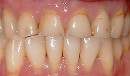 Cosmetic Crowns - Before